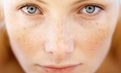 гиперпигментация кожи и как от нее избавиться